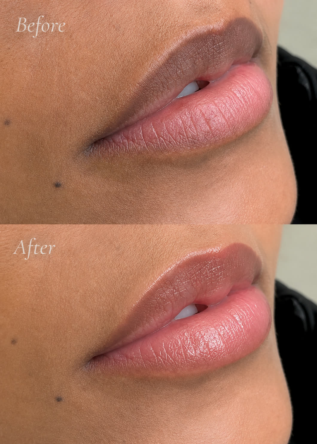 Lip neutralisation cosmetic tattoo before and after by Kellen Berkembrock at Berkem Brows Coolangatta