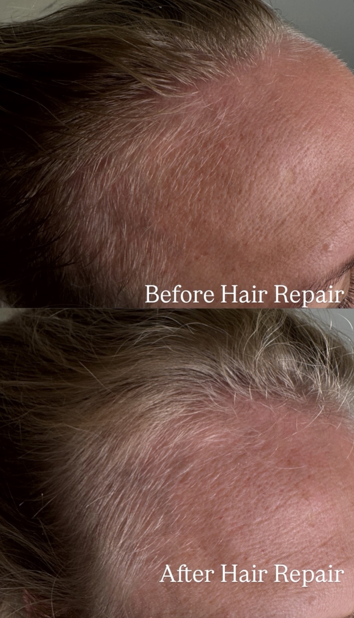 Brow and hair growth repair micro-needling at Berkem Brows Coolangatta